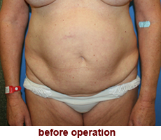 plastic-surgery-tummy-tuck